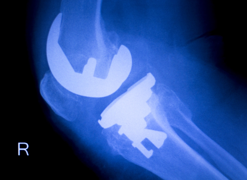 Why Do Orthopaedic Implants Need Chromium Oxide Coatings?